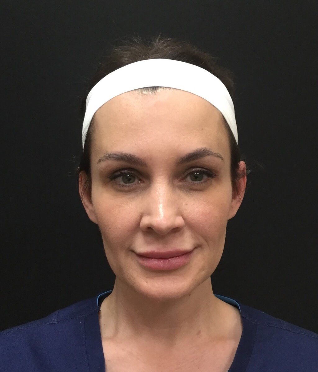 Series Of Sculptra Filler - Webster, TX