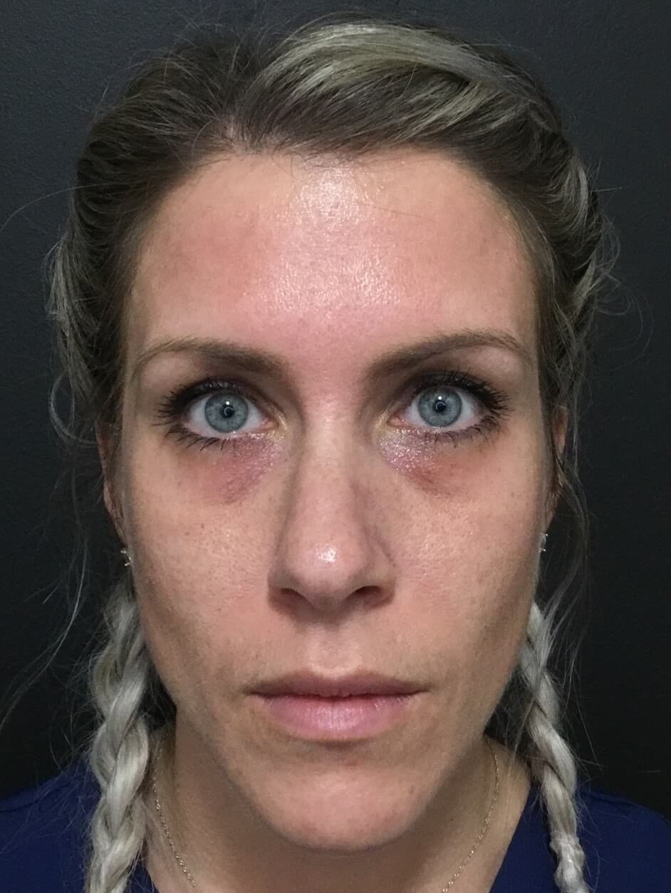 Before and After Restylane® Photos