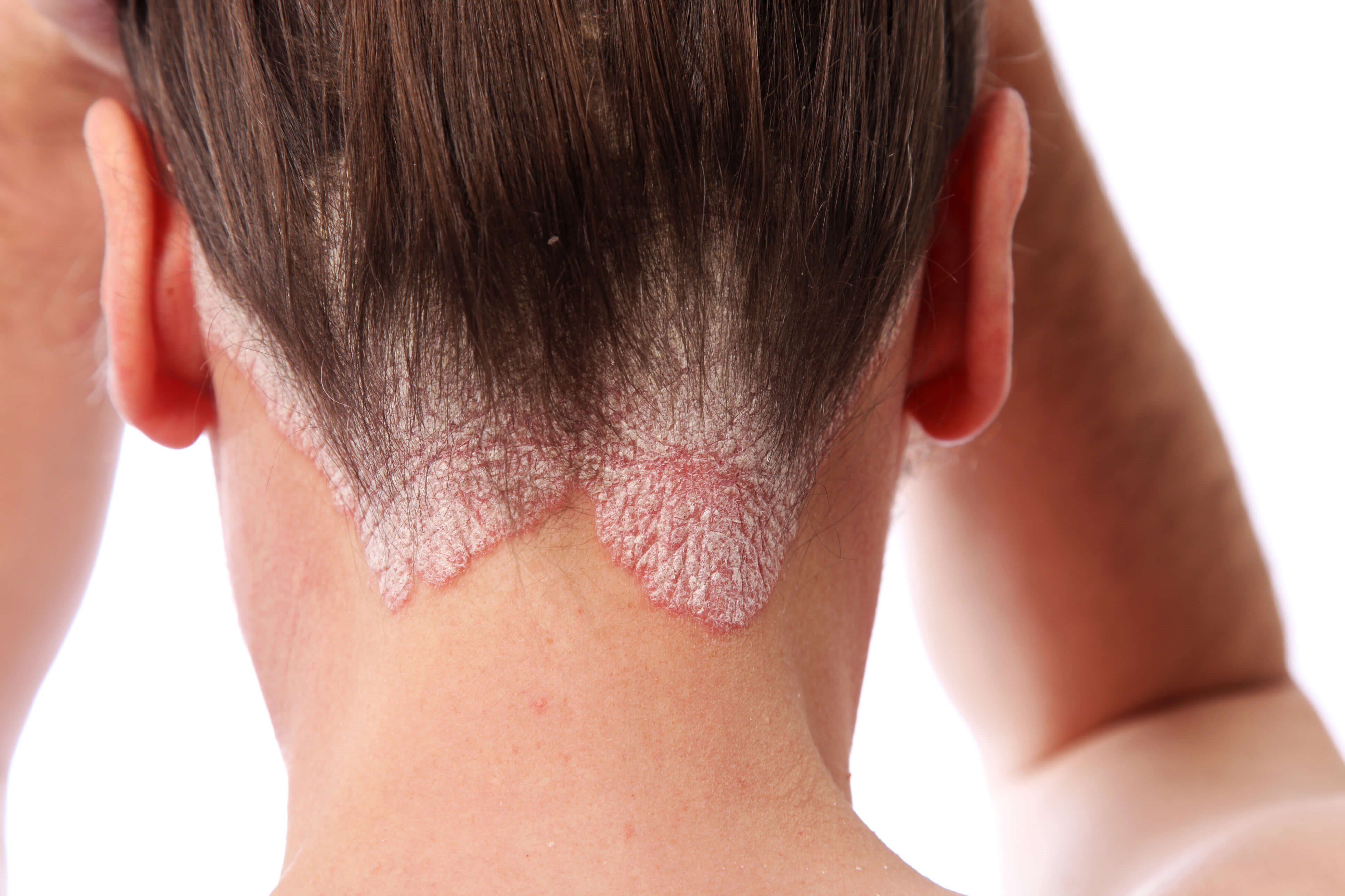 What is Psoriasis Can It Go Away Without Treatment