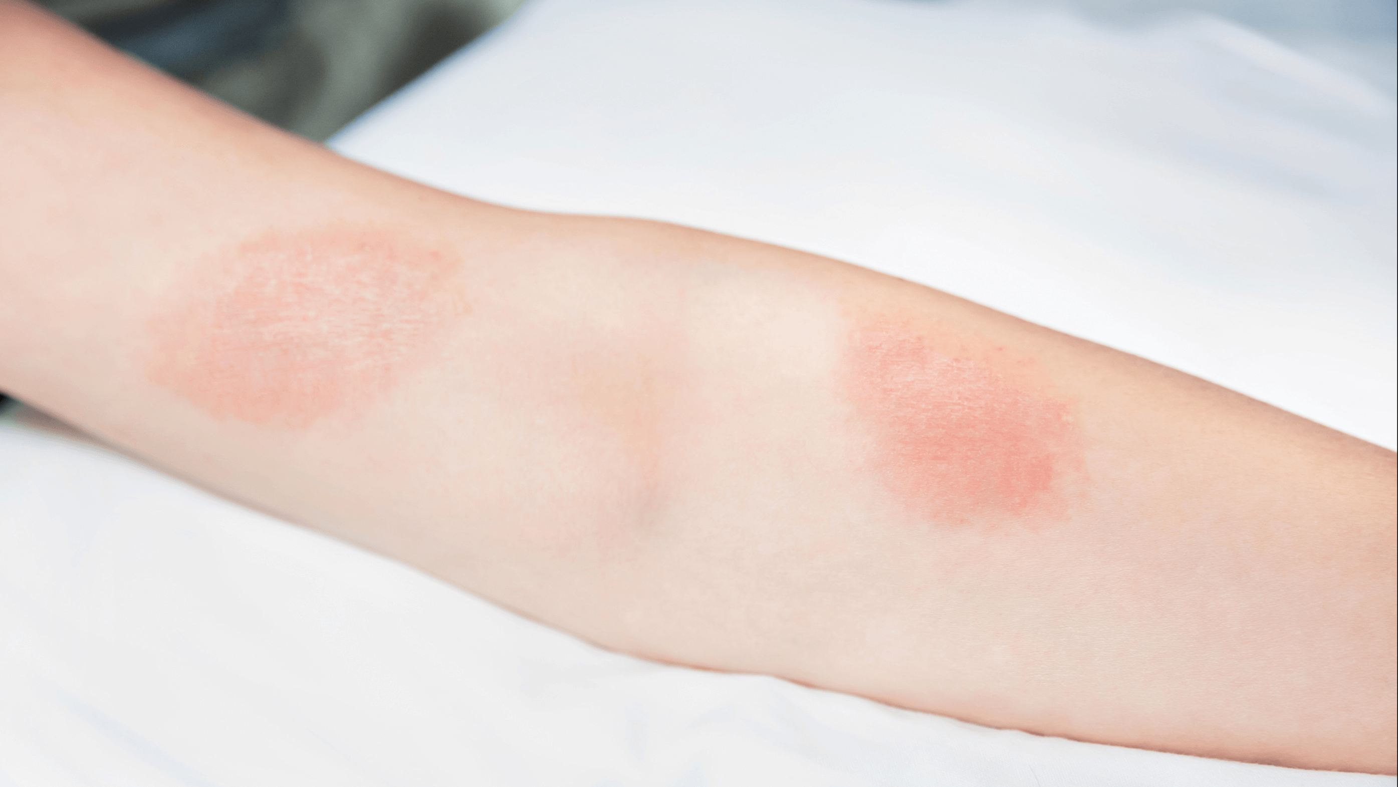 What Is Eczema?