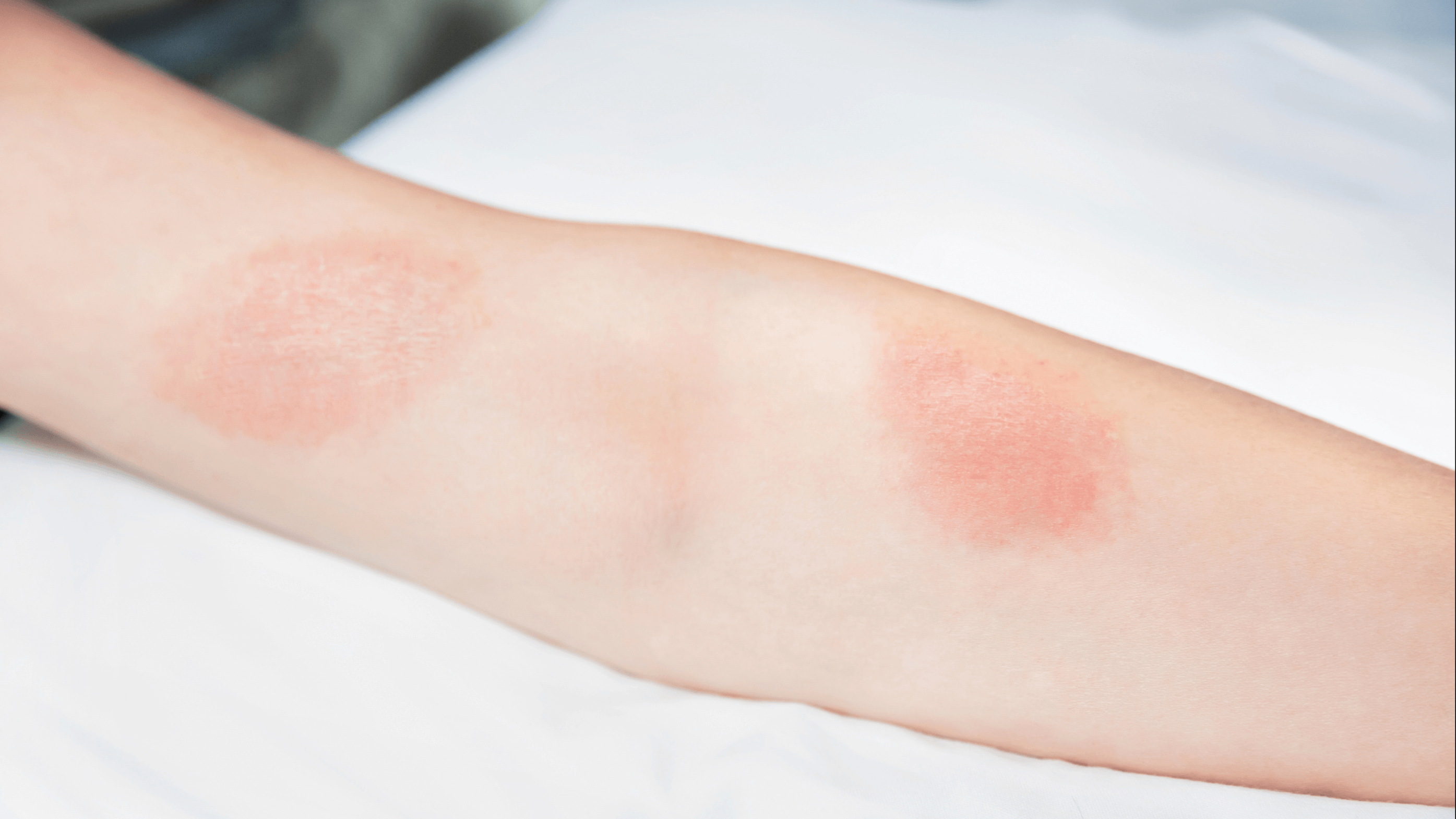 What Is Eczema? What Is Eczema?